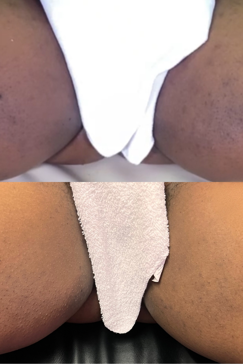 Melanin Magic Dark Spot & Acne Peel