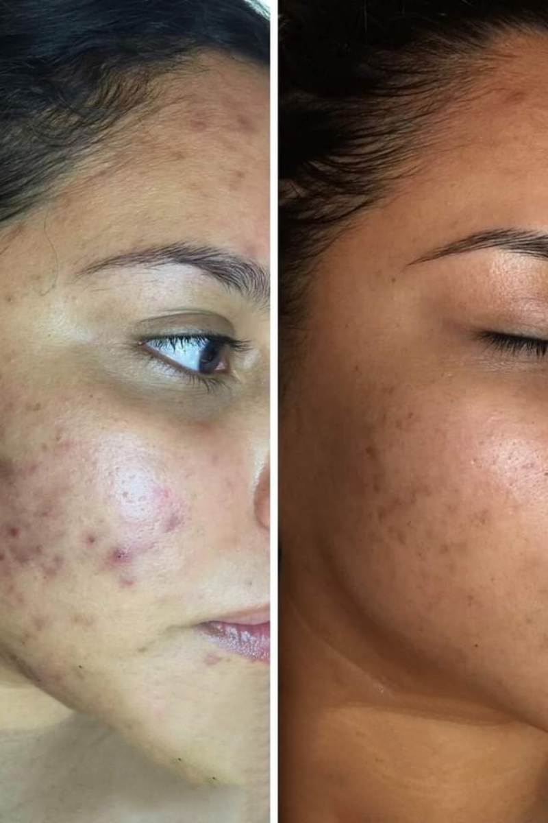 The Acne Kit (4 step)