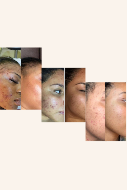 90 Day Virtual Skin Transformation Coaching