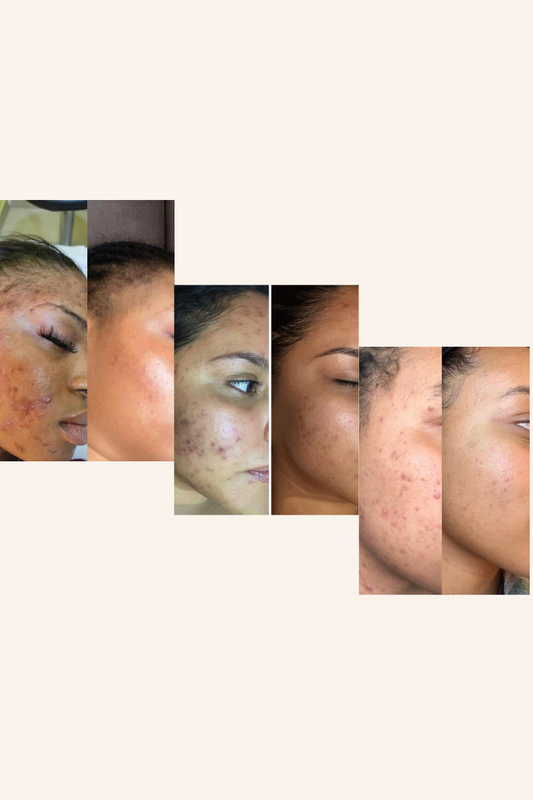 90 Day Virtual Skin Transformation Coaching