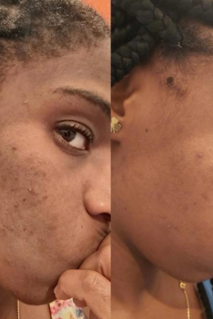 Turmeric & Kojic Brightening Pads