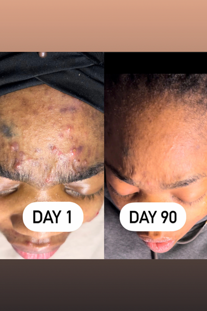 Melanin Magic Dark Spot & Acne Peel