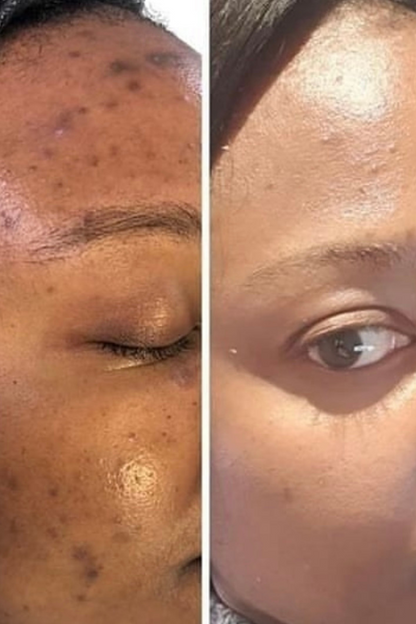 Complexion Glow Renewal System (5 pc)