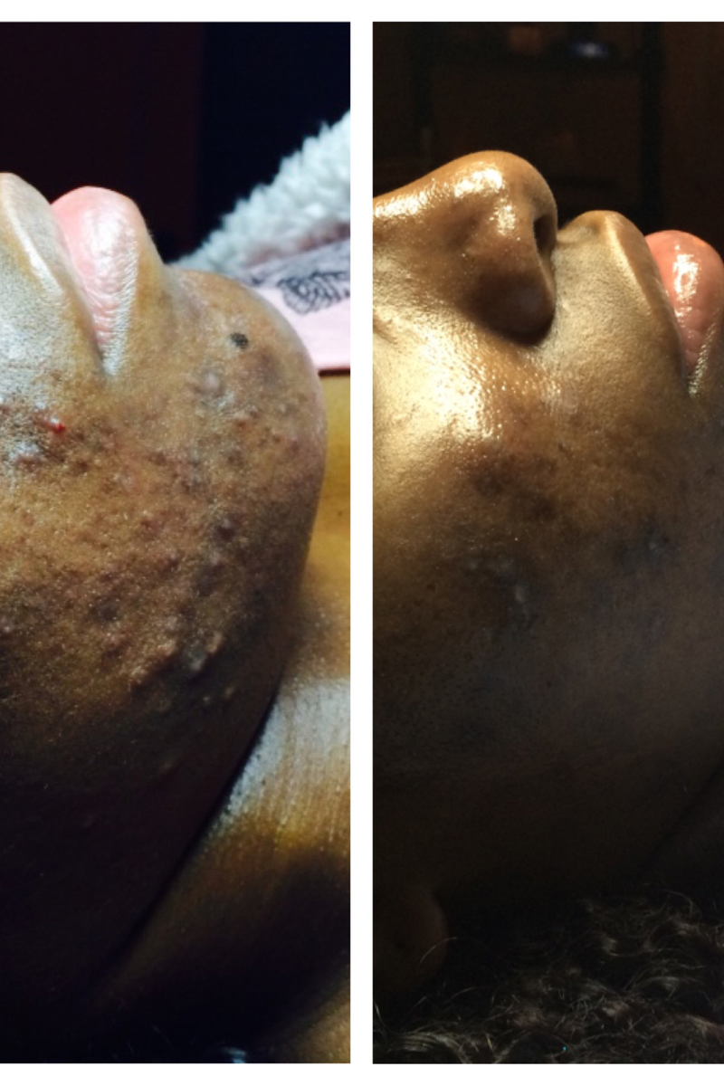 Melanin Magic Dark Spot & Acne Peel