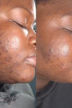 Load image into Gallery viewer, Melanin Magic Peel ( for Hyperpigmentation &amp; Acne)

