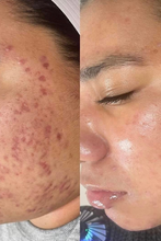 Load image into Gallery viewer, The Acne Kit (4 pc)

