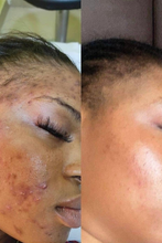 Load image into Gallery viewer, Melanin Magic Peel ( for Hyperpigmentation &amp; Acne)
