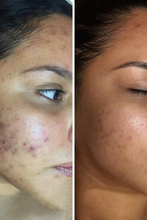 Load image into Gallery viewer, The Acne Kit (4 pc)
