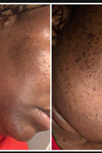 Load image into Gallery viewer, The Acne Kit (4 pc)
